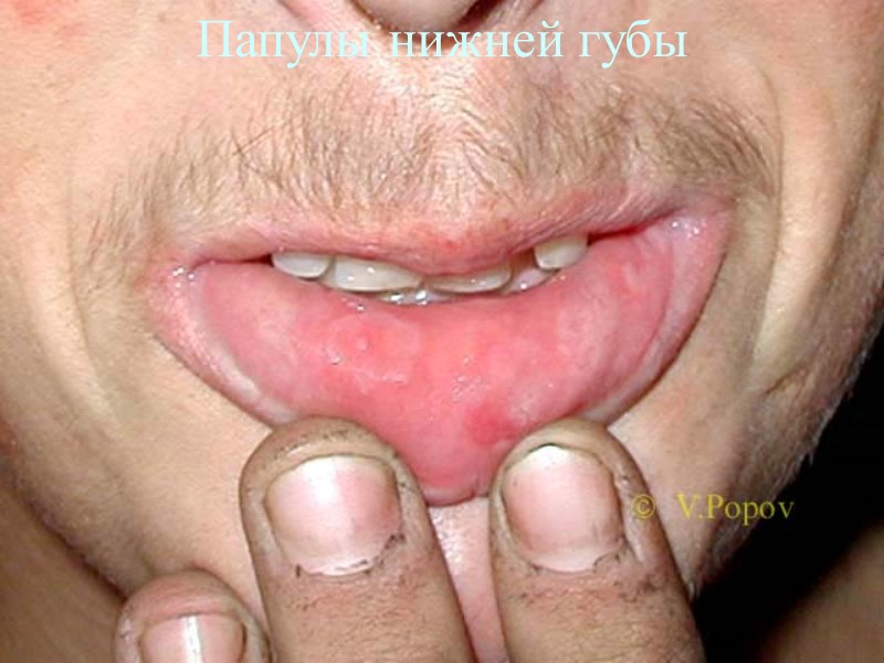 Папулы нижней губы